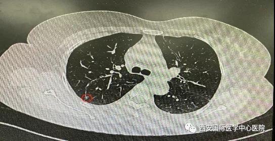 胸科醫(yī)院完成西北地區(qū)首例“Lung Pro全肺診療導(dǎo)航系統(tǒng)聯(lián)合單孔胸腔鏡下右肺上葉后段切除術(shù)”