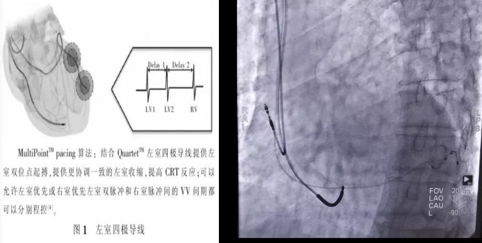 心臟病醫(yī)院心臟內(nèi)科首例心臟再同步治療除顫器（MPP-D）植入成功