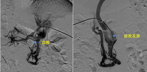 血栓攔路，如何破局——罕見巨大門靜脈血栓TIPS手術(shù)實錄