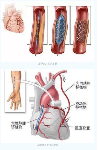 魚與熊掌不可兼得？冠脈雜交手術(shù)一站式解決問題