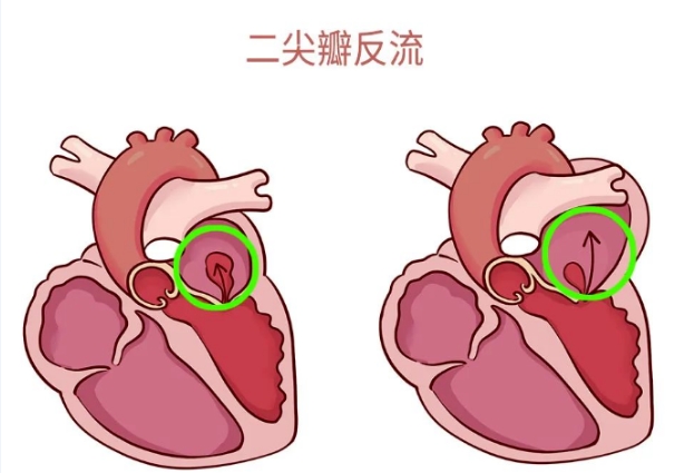 體檢報告里的心臟瓣膜反流，你讀懂了嗎？